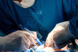Surgical equipment can sometimes emit smoke, having a proper device to perform surgical smoke evacuation is a must.